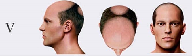 الگوی ریزش مو تیپ پنج
