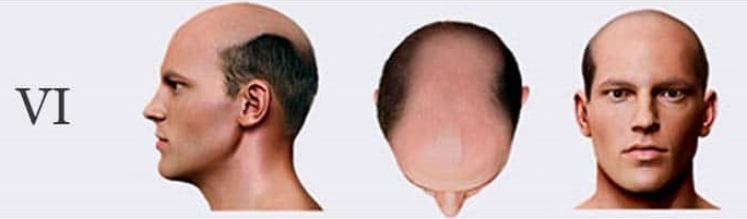الگوی ریزش مو تیپ شش