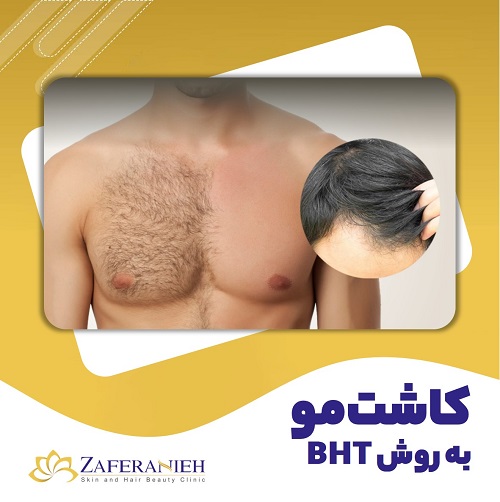 کاشت مو به روش BHT - کلینیک زعفرانیه