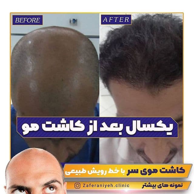 درمان ریزش مو - کلینیک پوست مو و زیبایی زعفرانیه
